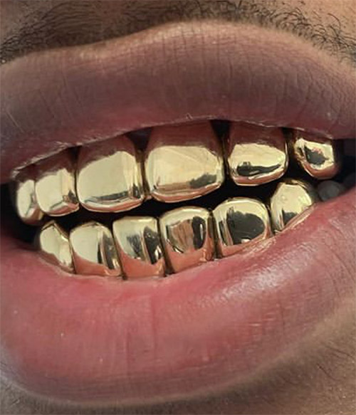 10K SOLID GOLD 6 TOP & 6 BOTTOM - Gold Teeth Master
