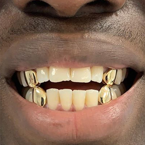 solid gold teeth
