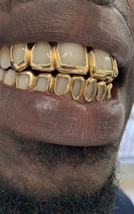 Our Gallery - Gold Teeth Master