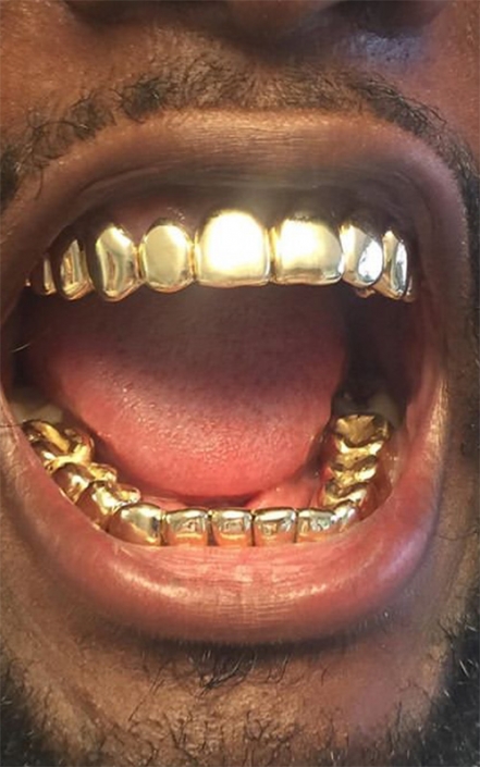 Our Gallery - Gold Teeth Master